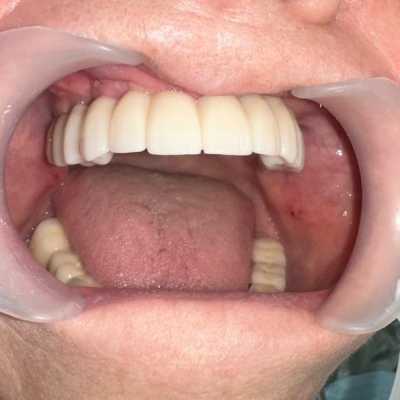 Lucrare dentară protetică fixă din ceramica pe zirconiu