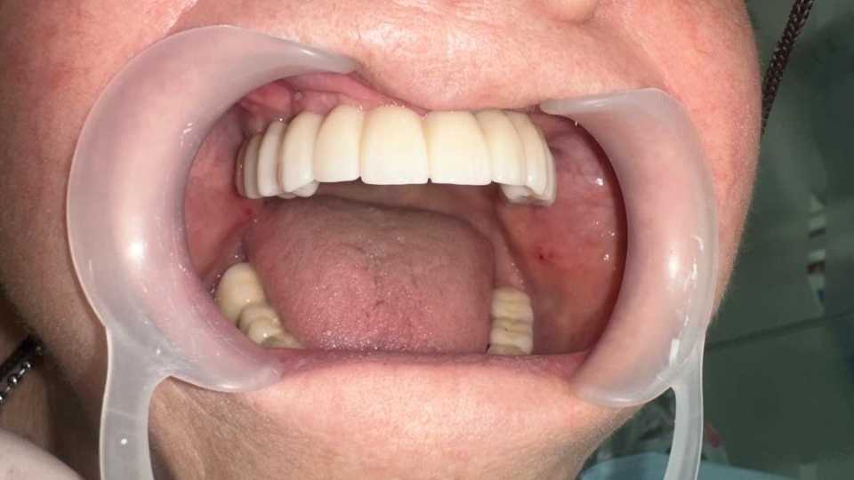 Lucrare dentară protetică fixă din ceramica pe zirconiu