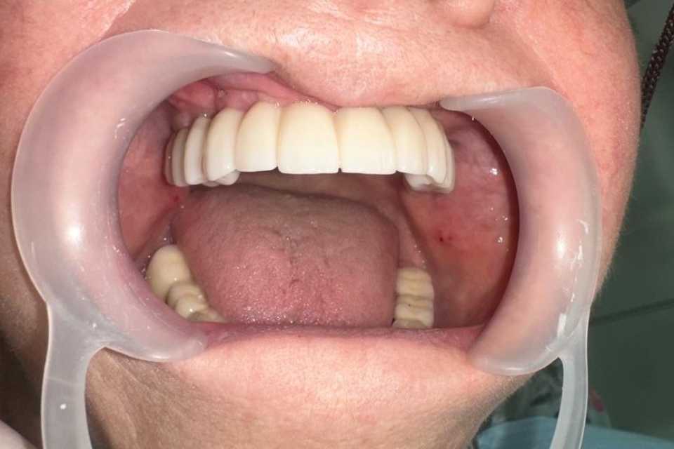 Lucrare dentară protetică fixă din ceramica pe zirconiu