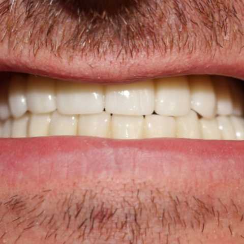 Lucrări fixe cimentate la nivelul maxilarului din ceramica pe zirconiu
