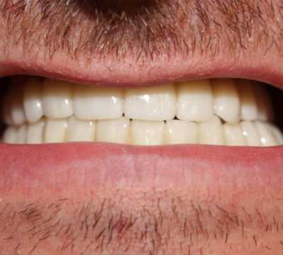 Lucrări fixe cimentate la nivelul maxilarului din ceramica pe zirconiu