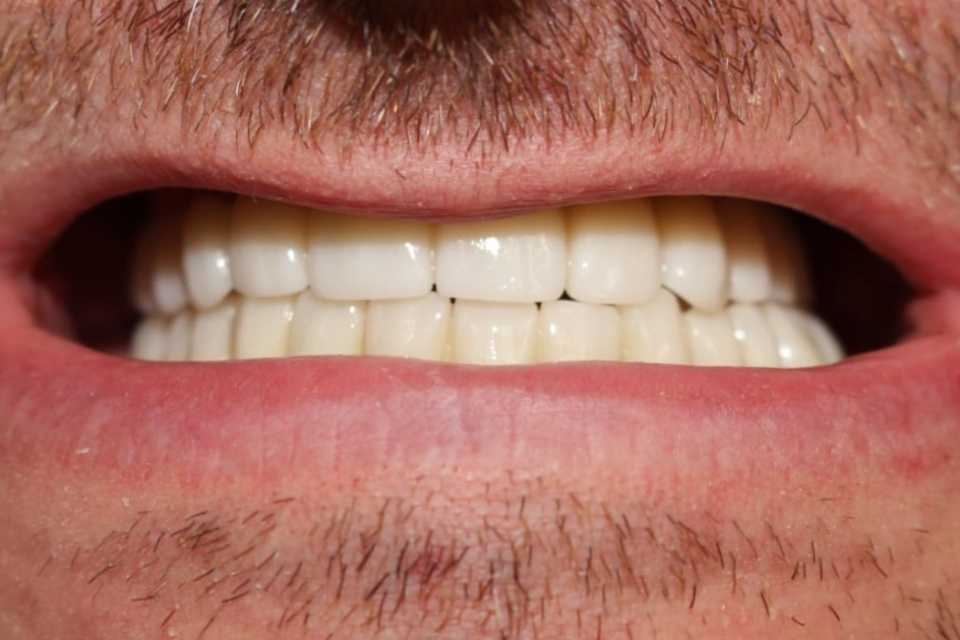 Lucrări fixe cimentate la nivelul maxilarului din ceramica pe zirconiu