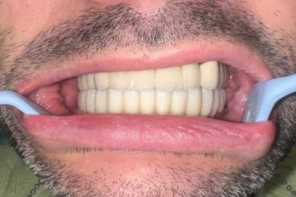 Implanturi dentare Mega Gen Anyridge și elemente ceramice pe zirconiu