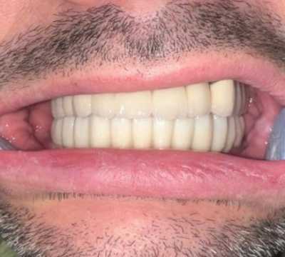 Implanturi dentare Mega Gen Anyridge și elemente ceramice pe zirconiu