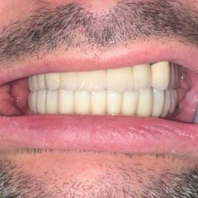 Implanturi dentare Mega Gen Anyridge și elemente ceramice pe zirconiu