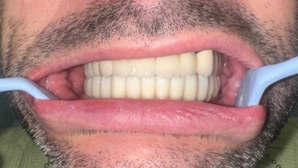 Implanturi dentare Mega Gen Anyridge și elemente ceramice pe zirconiu
