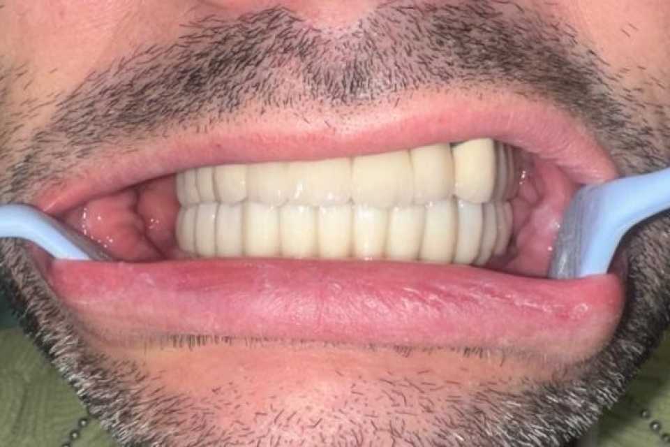 Implanturi dentare Mega Gen Anyridge și elemente ceramice pe zirconiu