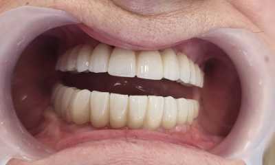 Implanturi dentare și punți fixe de ceramica pe zirconiu