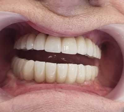 Implanturi dentare și punți fixe de ceramica pe zirconiu