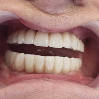 Implanturi dentare și punți fixe de ceramica pe zirconiu