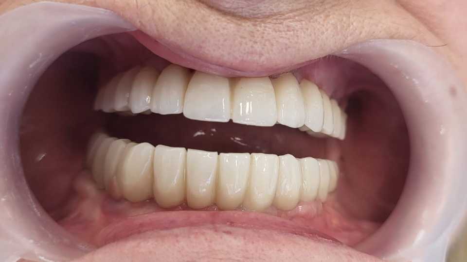 Implanturi dentare și punți fixe de ceramica pe zirconiu