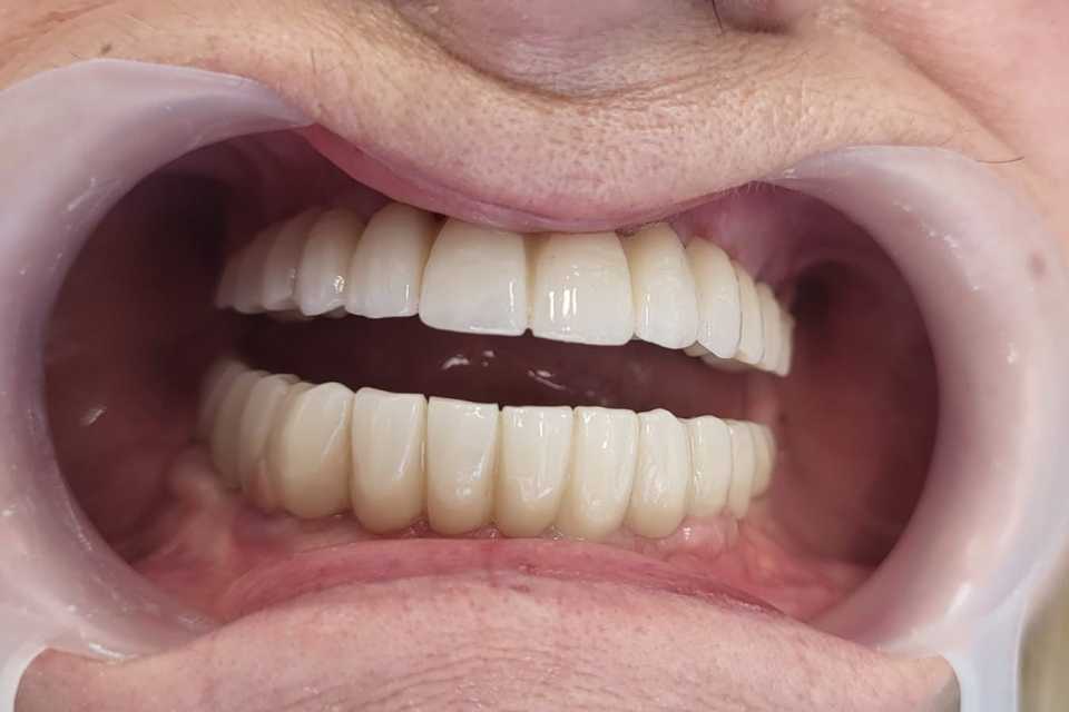 Implanturi dentare și punți fixe de ceramica pe zirconiu