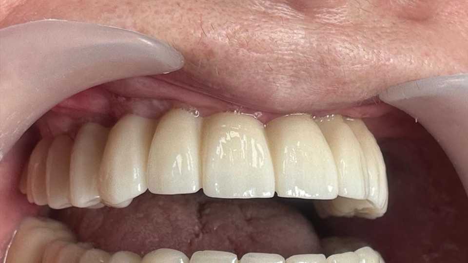 Implanturi orale speciale zigomatice și pterigoide