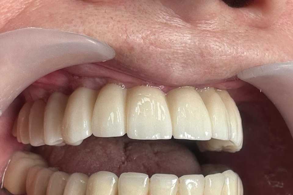 Implanturi orale speciale zigomatice și pterigoide