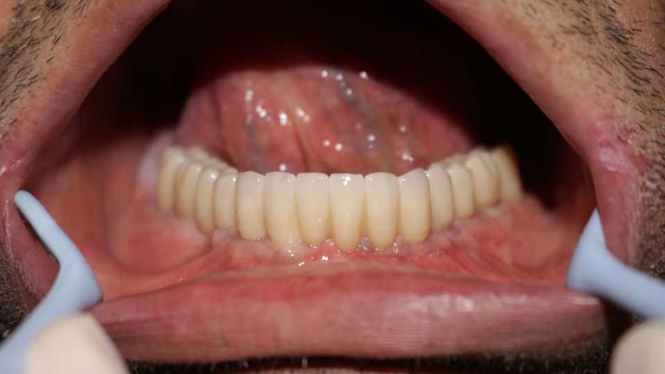 Reabilitare orală cu implanturi dentare Paltop, protezate cu lucrare insurubabila fixa din ceramica pe suport de zirconiu
