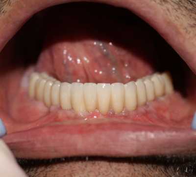 Reabilitare orală cu implanturi dentare Paltop, protezate cu lucrare insurubabila fixa din ceramica pe suport de zirconiu