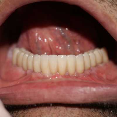 Reabilitare orală cu implanturi dentare Paltop, protezate cu lucrare insurubabila fixa din ceramica pe suport de zirconiu