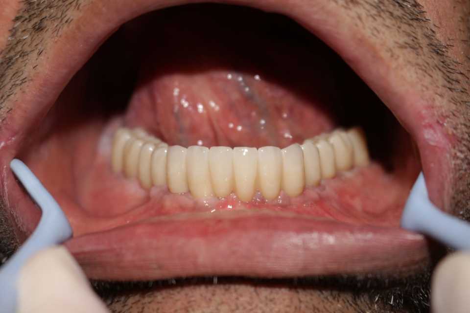 Reabilitare orală cu implanturi dentare Paltop, protezate cu lucrare insurubabila fixa din ceramica pe suport de zirconiu