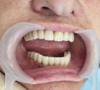 Reabilitare implaturi Anyridge si lucrari dentare ceramica pe zirconiu