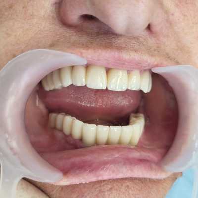 Reabilitare implaturi Anyridge si lucrari dentare ceramica pe zirconiu