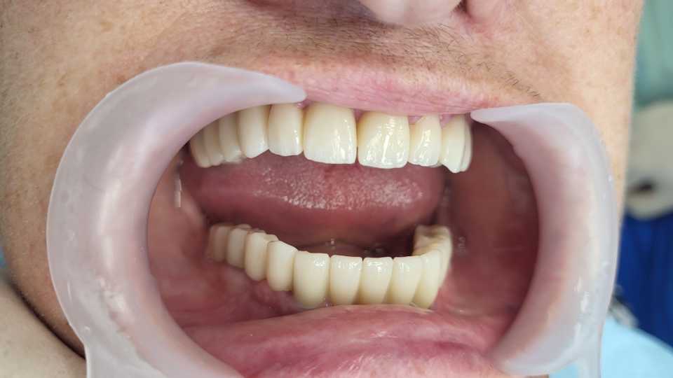 Reabilitare implaturi Anyridge si lucrari dentare ceramica pe zirconiu
