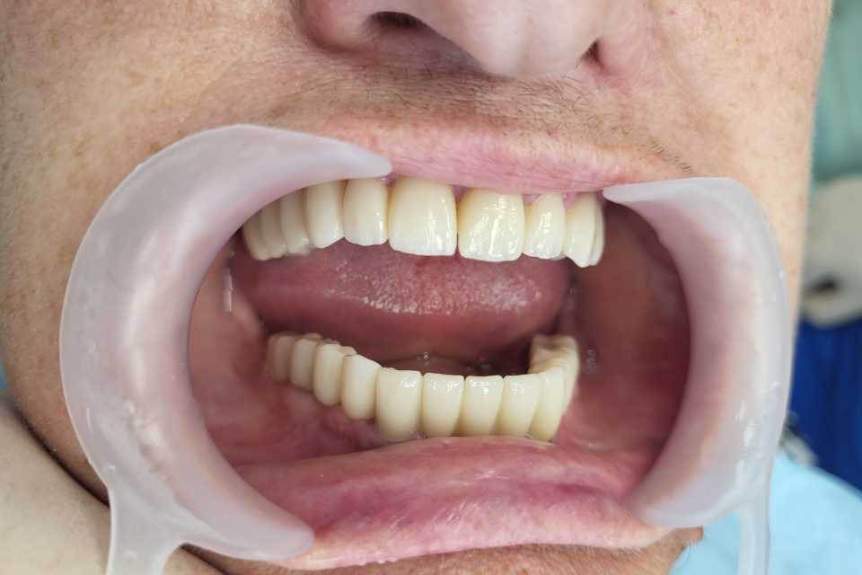 Reabilitare implaturi Anyridge si lucrari dentare ceramica pe zirconiu