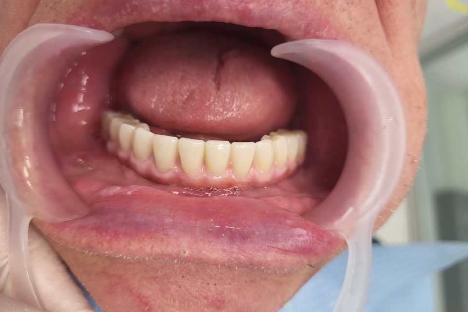 Implanturi mandibulă și lucrare înșurabilă ceramică