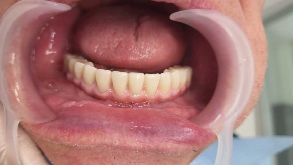 Implanturi mandibulă și lucrare înșurabilă ceramică