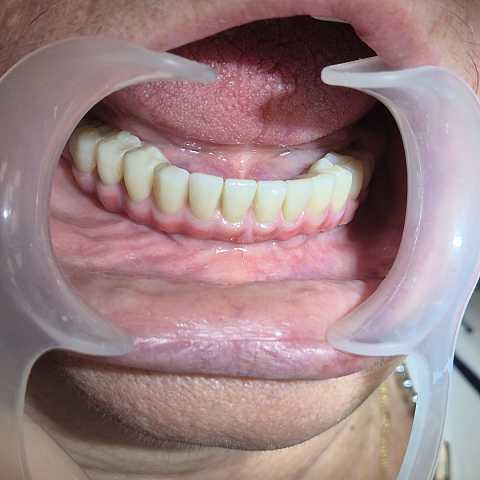 Implanturi AnyRidge inserate interforaminal