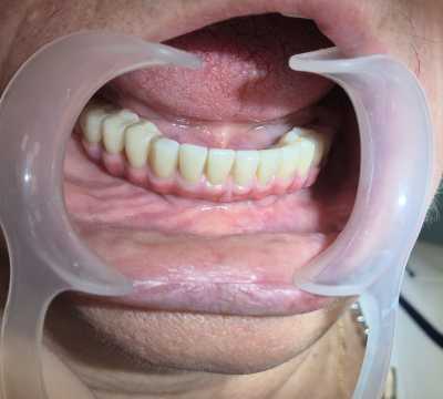 Implanturi AnyRidge inserate interforaminal