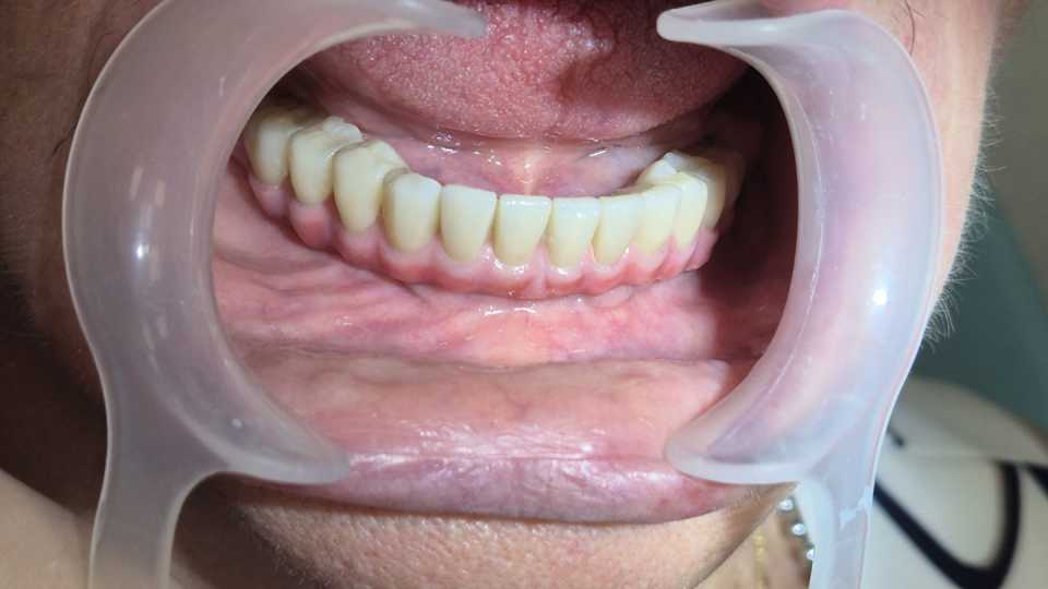 Implanturi AnyRidge inserate interforaminal