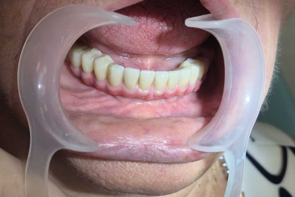 Implanturi AnyRidge inserate interforaminal