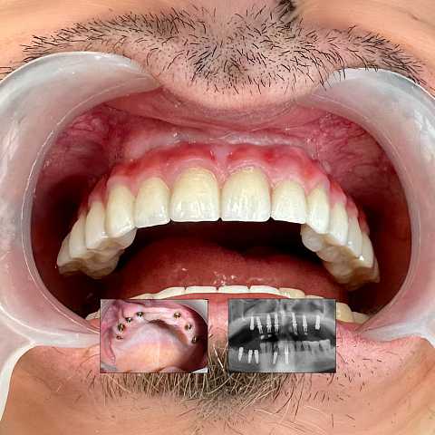 Implaturi si sinus lift