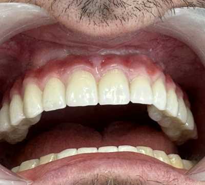 Implaturi si sinus lift