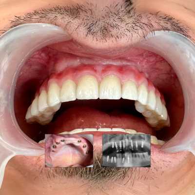 Implaturi si sinus lift