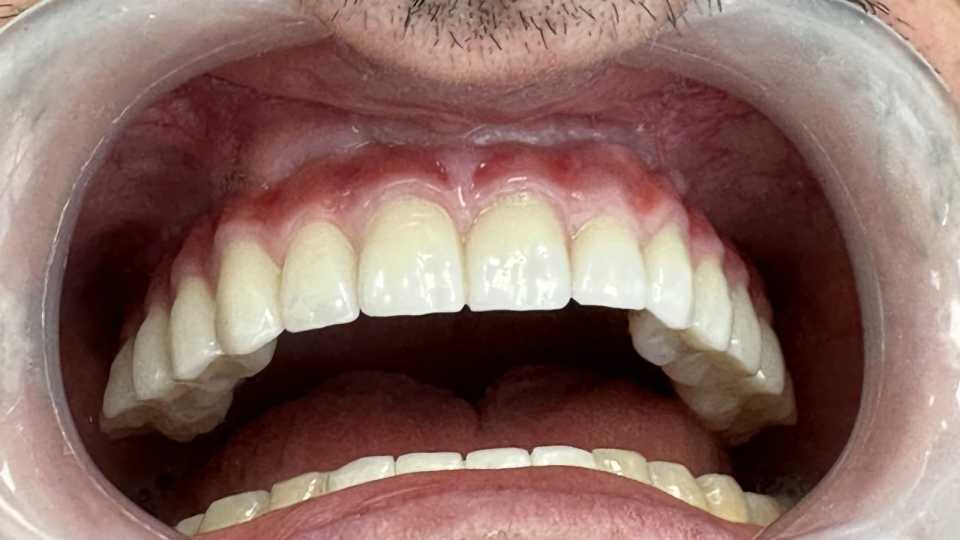 Implaturi si sinus lift