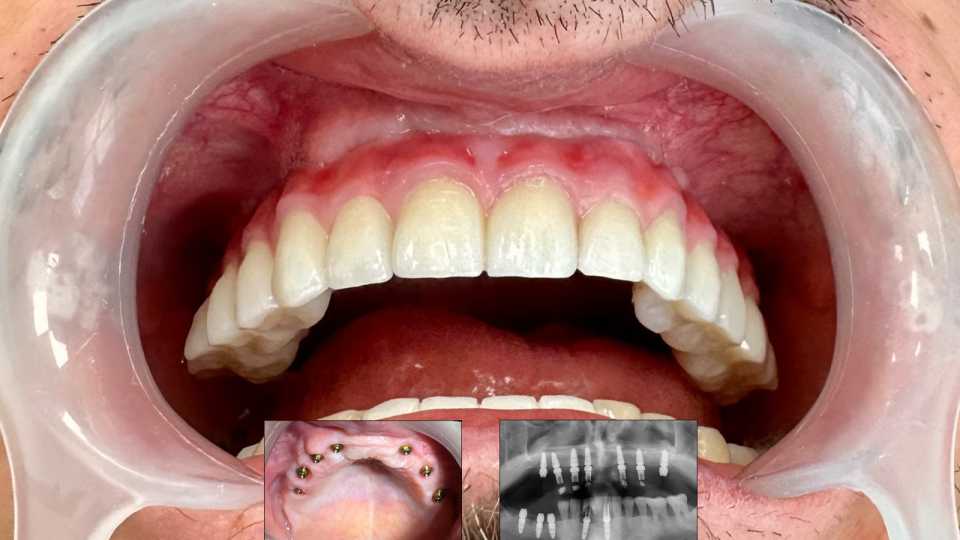 Implaturi si sinus lift