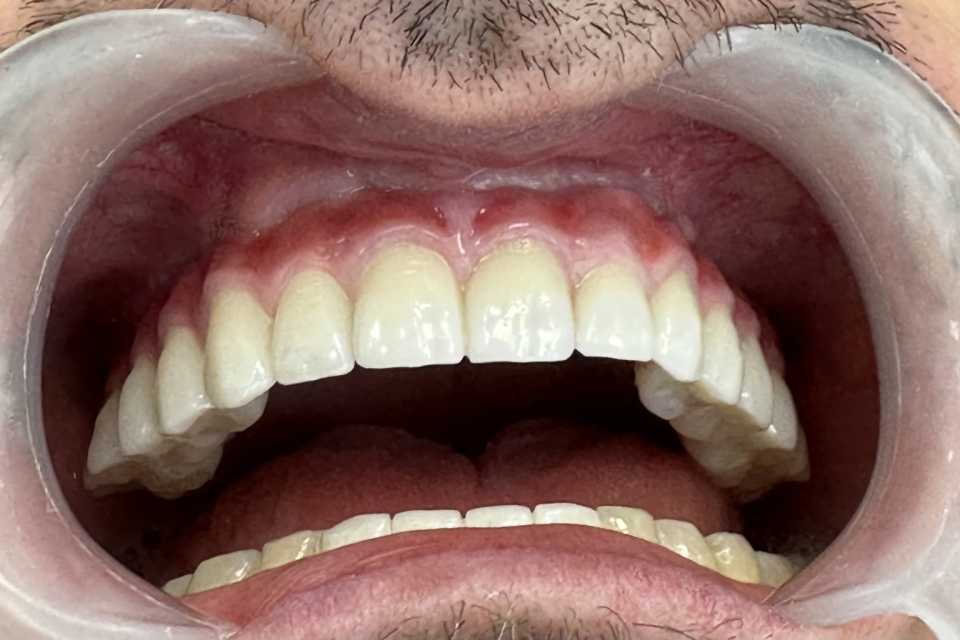 Implaturi si sinus lift