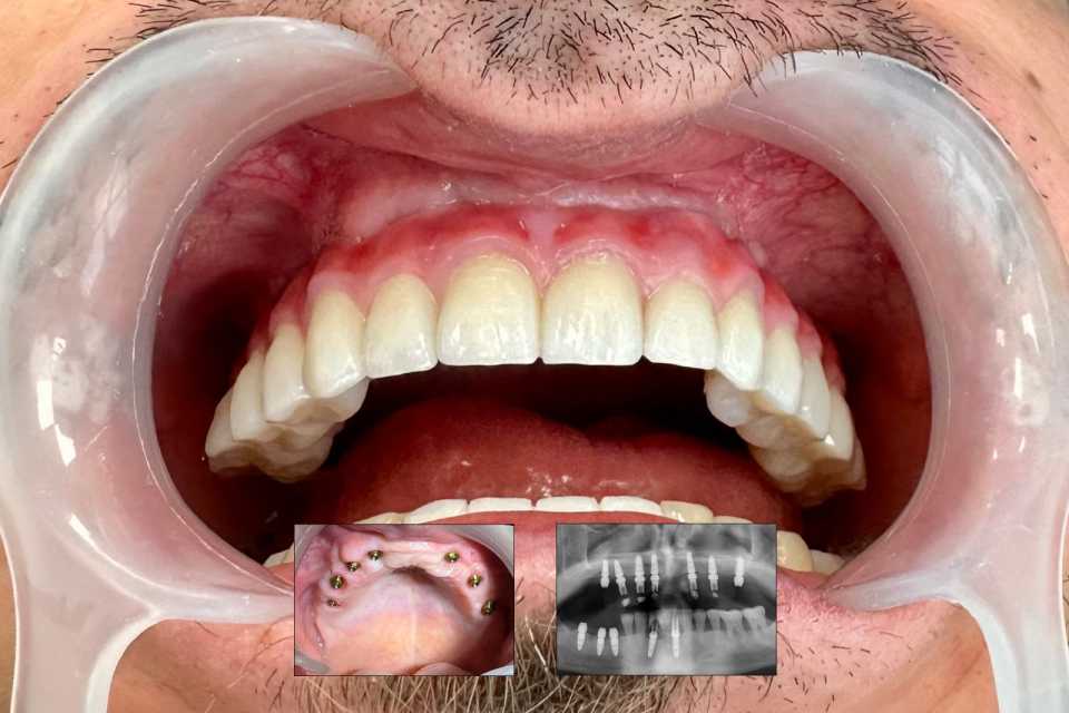 Implaturi si sinus lift