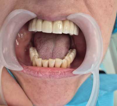 Reabilitare implaturi Mega Gen Anyridge