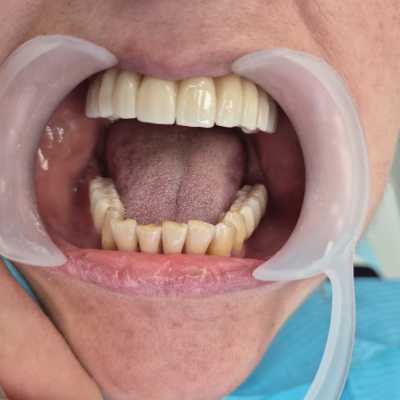 Reabilitare implaturi Mega Gen Anyridge