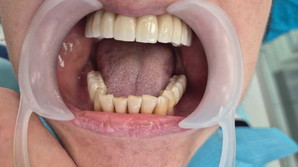 Reabilitare implaturi Mega Gen Anyridge