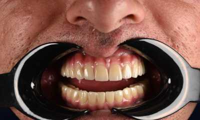 All-on-X – dinți ficși într-o singură zi, o nouă viață pentru zâmbetul tău