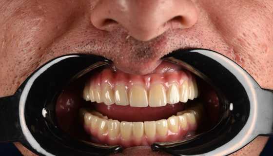 All-on-X – dinți ficși într-o singură zi, o nouă viață pentru zâmbetul tău