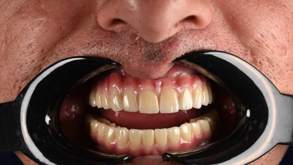 All-on-X – dinți ficși într-o singură zi, o nouă viață pentru zâmbetul tău