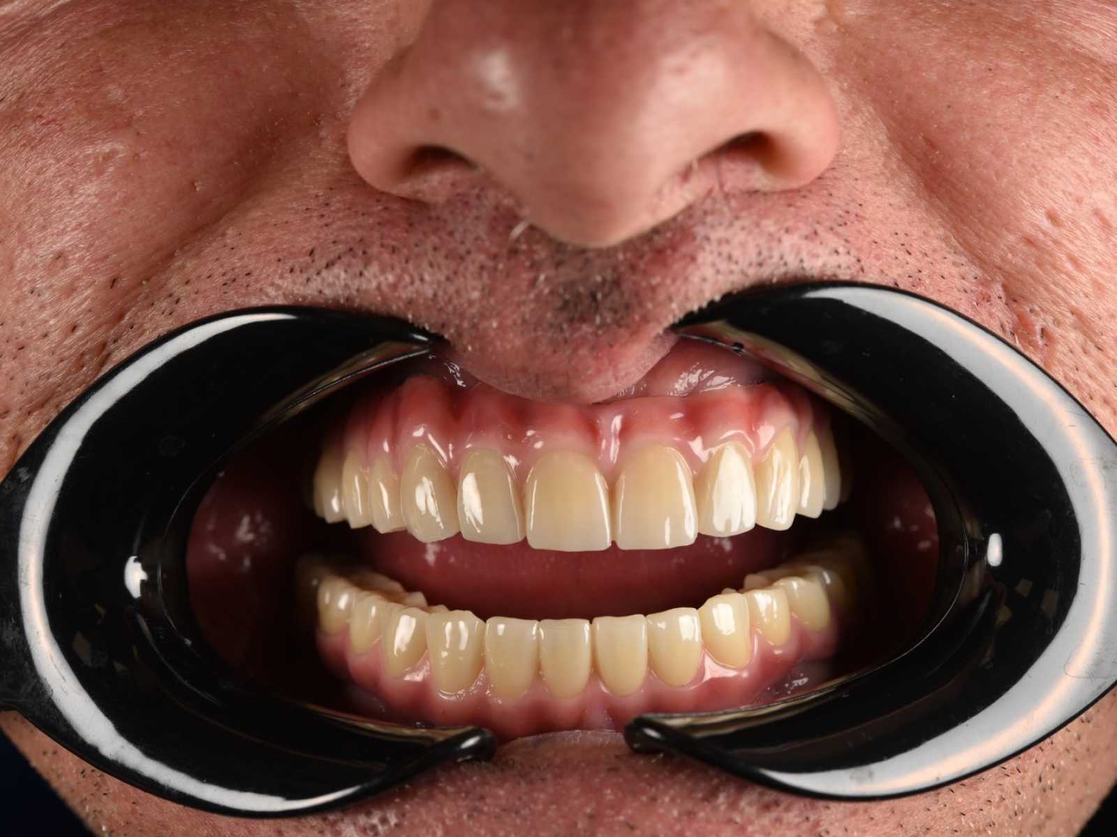 Dinți ficși într-o singură zi.