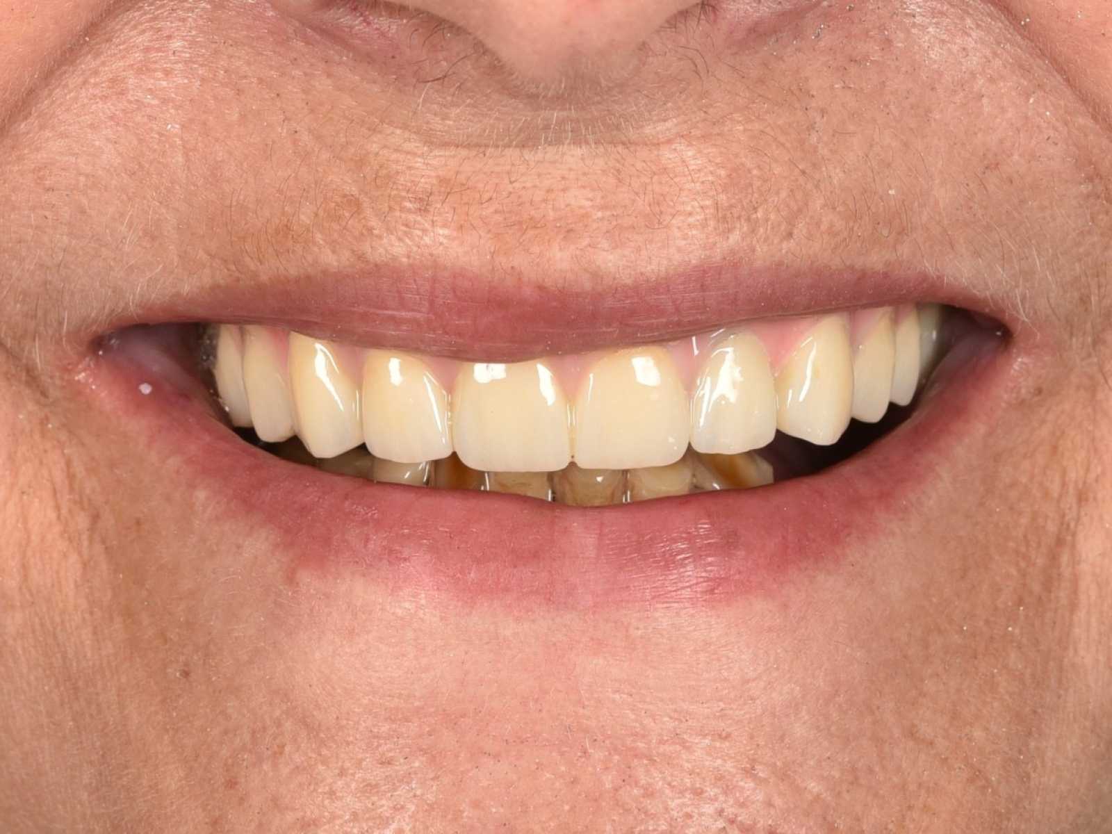 Dinți ficși într-o singură zi.