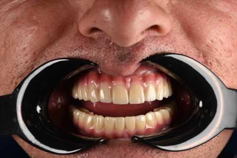 All-on-X – dinți ficși într-o singură zi, o nouă viață pentru zâmbetul tău