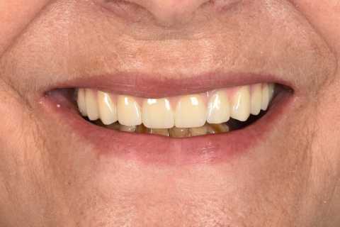 All-on-X – dinți ficși într-o singură zi, o nouă viață pentru zâmbetul tău