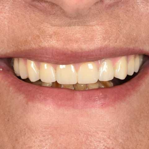 All-on-X – dinți ficși într-o singură zi, o nouă viață pentru zâmbetul tău